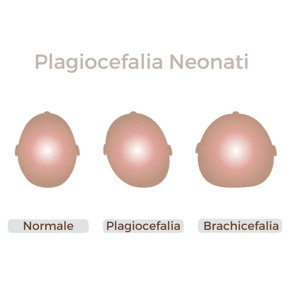 Plagiocefalia cos'è - Dilamababy